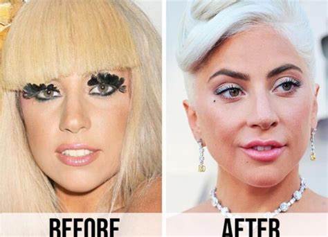 A Surgeon Breaks Down Lady Gaga’s Potential Cosmetic